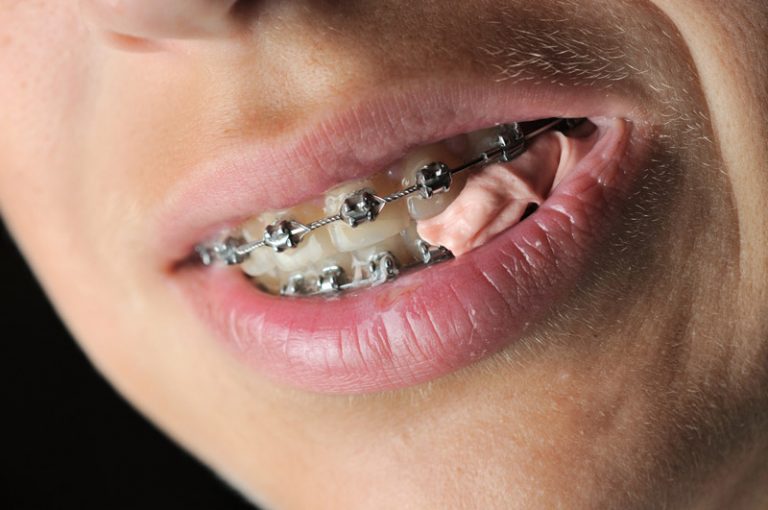 Can You Eat Gum with Braces?