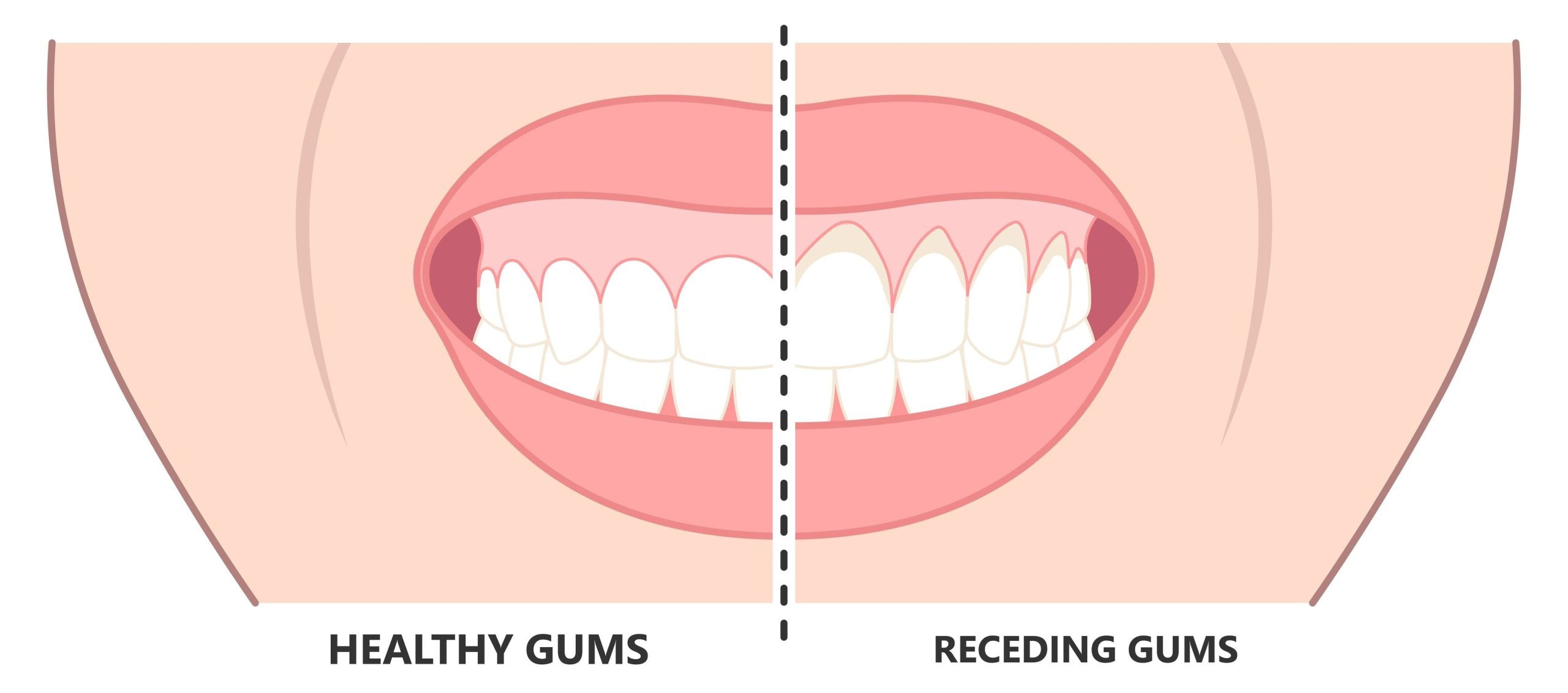 How Far Can Gums Recede Before Teeth Fall Out? - Oclean