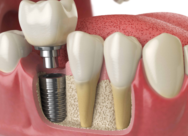 How Much are Dental Implants?