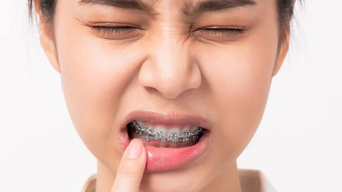 Do Braces Hurt? What to Expect and How to Manage