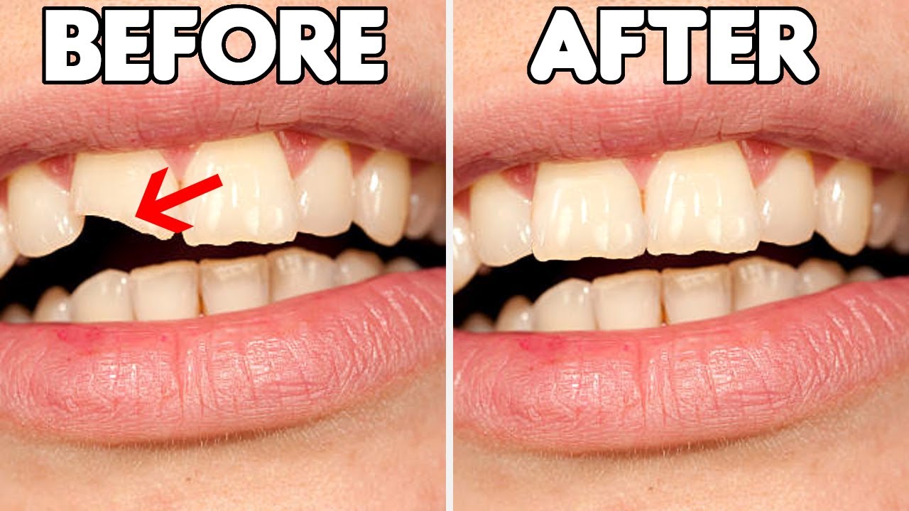 How Much Does It Cost to Fix a Chipped Tooth?