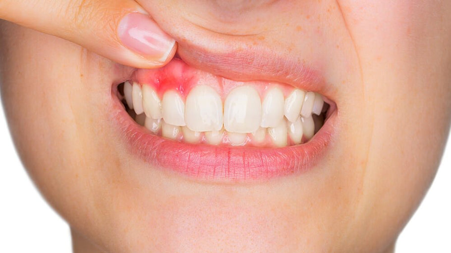 Is Gingivitis Contagious? Science Facts About Gum Disease Transmission