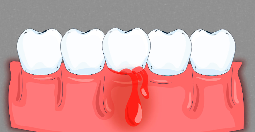 Why Do My Gums Bleed When I Floss?