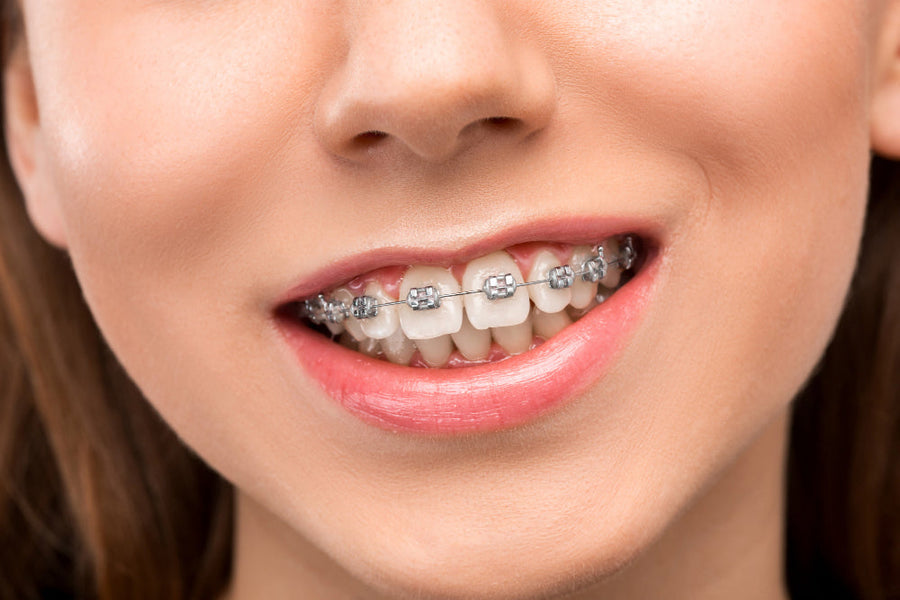 How Long Do You Have to Wear Braces?