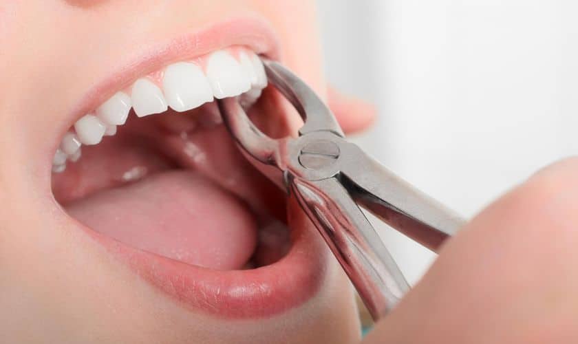 How Long Does a Tooth Extraction Take to Heal?