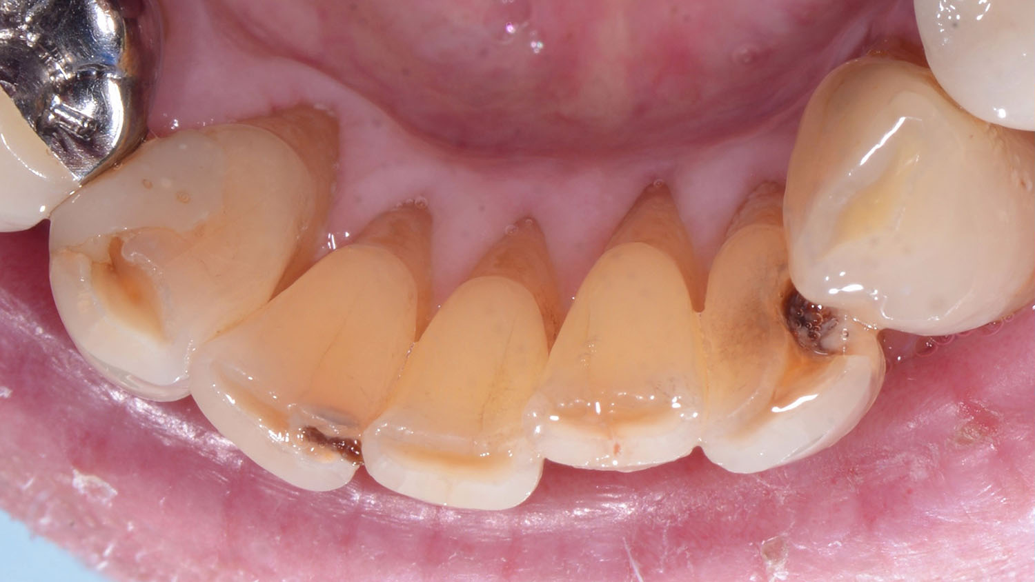 Can an Exposed Tooth Root Cause Double Vision?