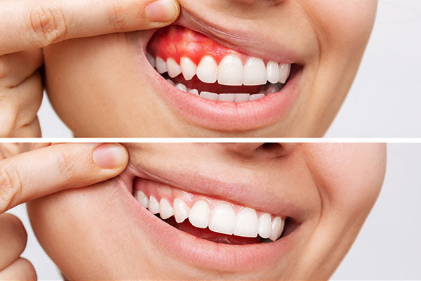 How to Cure Gum Disease Without a Dentist