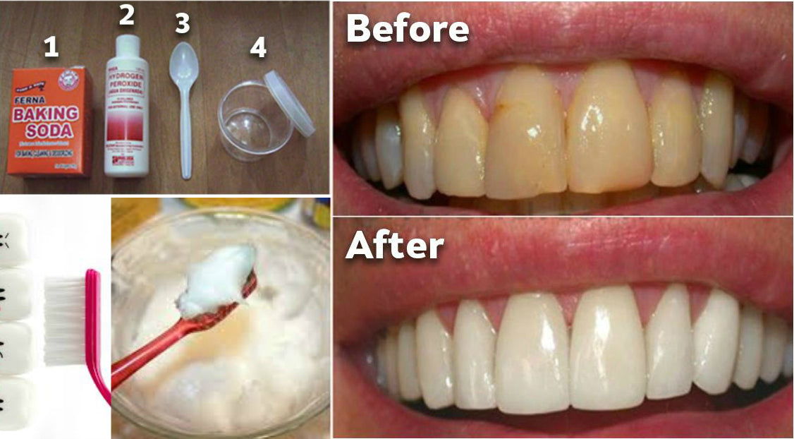 How to Remove Tartar from Teeth Without a Dentist