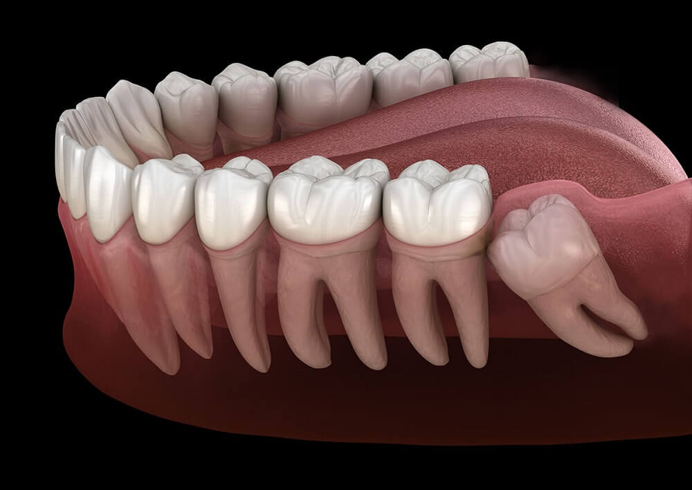How Wisdom Teeth Grow When Do Wisdom Teeth Come In? Signs, Symptoms & Treatment Guide